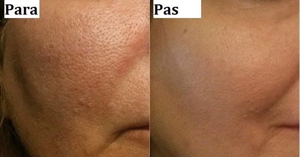 Maskë perfekte për eliminimin e poreve në kushte shtëpie